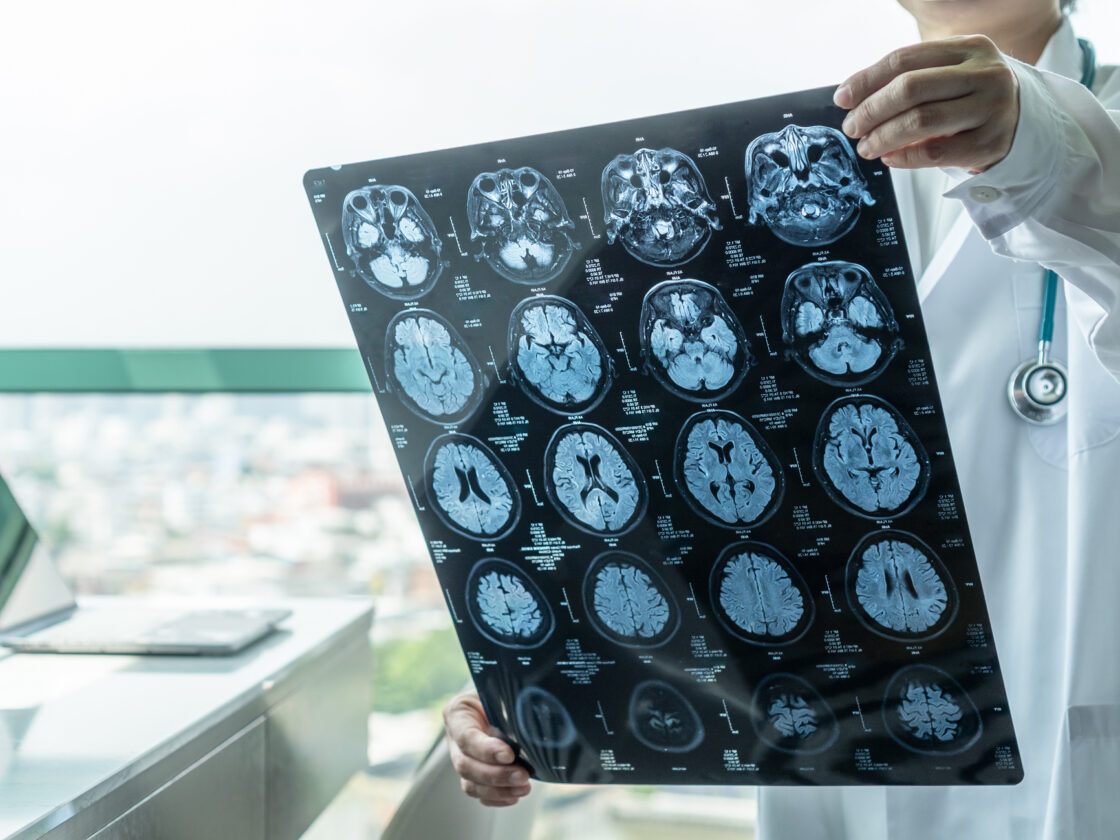 medical doctor seeing Magnetic Resonance Imaging (MRI) film