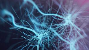 stroke case study